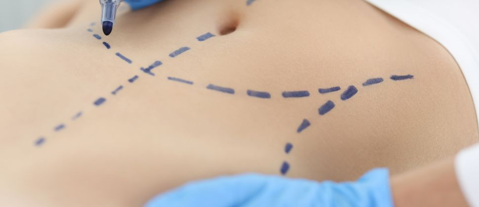 How Does A Drainless Tummy Tuck Work?